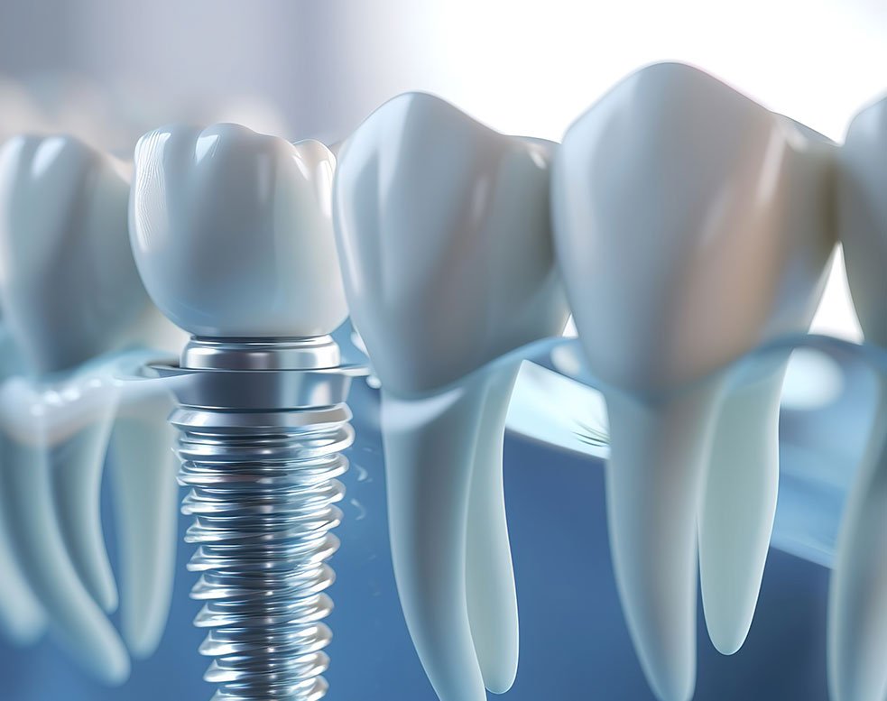 3D illustration of a dental implant with crown placed in the jaw alongside natural teeth.
